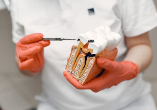 jak pozbyć się próchnicy