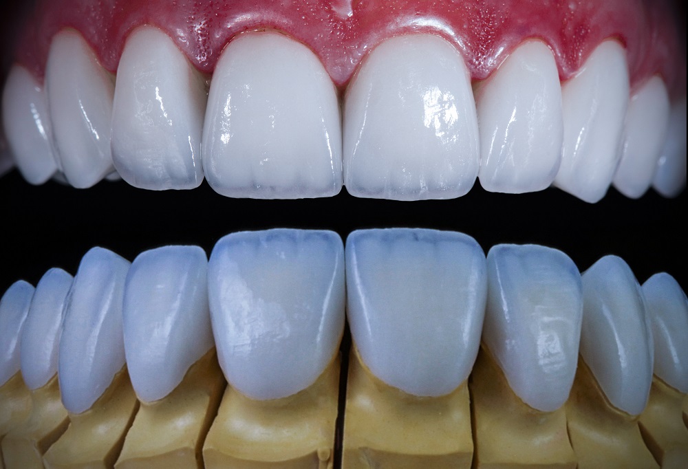 Korony pełnoceramiczne Korony pełnoceramiczne