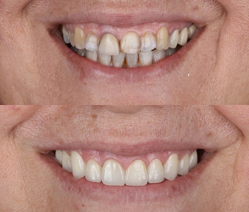 Licówki kompozytowe